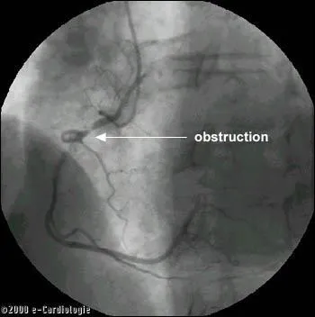 Citez les examens complémentaires à réaliser lors d'une crise d'angor :