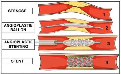 Quel examen coronaire précoce est plus efficace que la thrombolyse, dans les 6 premières heures suivant le début de la douleur liée à l'infarctus du myocarde ?