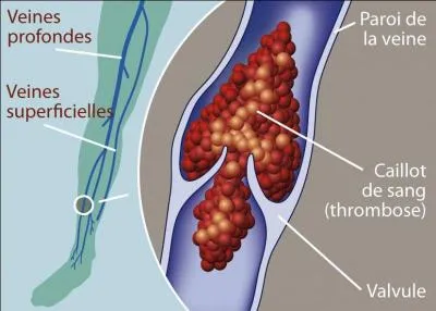 Cocher les bonnes réponses. Trois facteurs peuvent favoriser la thrombose veineuse :