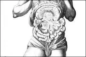 Que signifie "atrabilaire" ?