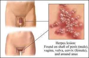 Contre quelle maladie les antibiotiques ou autres traitements ne peuvent rien ?