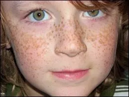 Quel est le nom scientifique des taches de rousseur ?