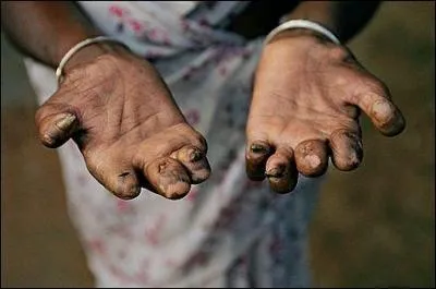 À quel bacille doit-on la lèpre ?