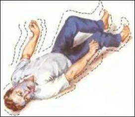 Les francs mitoux ou sabouleux sont malades et cherchent à apitoyer les passants.
De quoi souffrent-ils ?