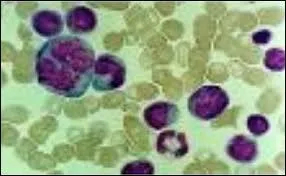 Comment une tumeur peut-elle apparaître ?