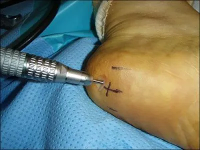 Quelle pathologie ne concerne pas le pied ?