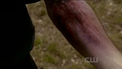 Quel est le remède à une morsure de loup-garou ?