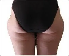 Véritable hantise pour de nombreuses femmes, cette augmentation de volume de la partie du corps, partant du bassin et allant aux cuisses, porte le gentil nom de :