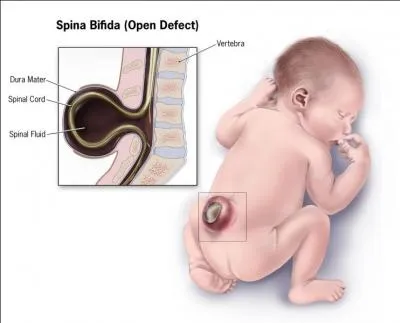 Un ftus a été opéré récemment "in utéro", une première. De quoi souffrait-il ?