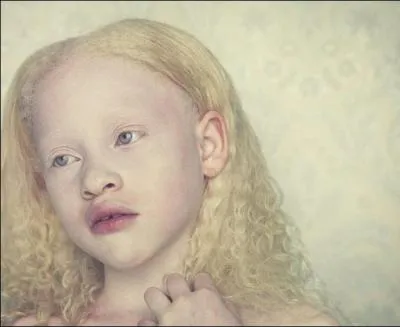 À quoi est dû l'albinisme ?