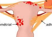 Quiz Que savez-vous de l'endomtriose ?