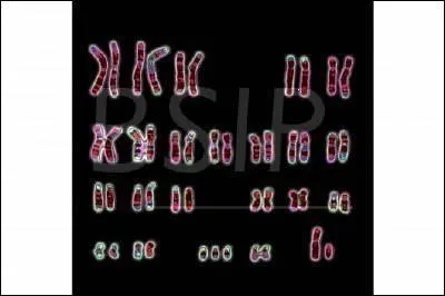 Un individu atteint de trisomie 21 présente :