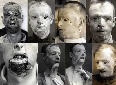 Qui appelait-on les gueules cassées ? Attention, photo très dure !