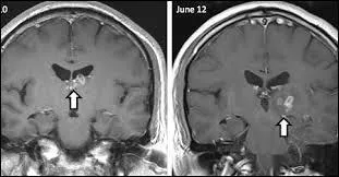 Un britannique a vécu 4 ans avec un ver d'un centimètre de longueur coincé dans son cerveau.
