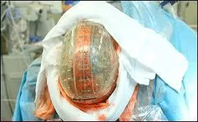 Où se situe le cerveau dans la tête ?