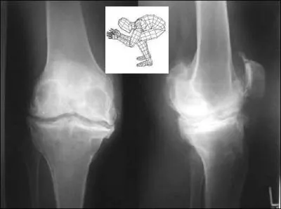 Nous sommes en milieu de radiologie et l'on y emploie des mots imagés mais professionnels.
Un cliché postéro-antérieur du genou à 30° de flexion traduit l'incidence de ---------.