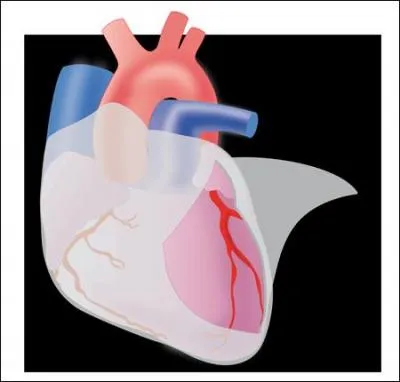 Comment s'appelle l'infection de la paroi qui tapisse l'intérieur du coeur ?