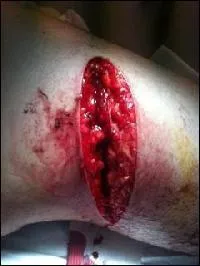 Quel ingrédient essentiel était systématiquement appliqué sur les plaies ouvertes ?