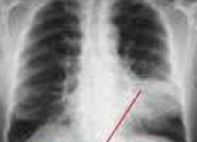 Quiz Le savoir peut mener  la gurison : la pneumonie. (2)