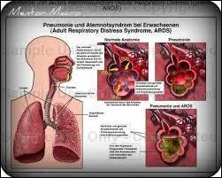 Si vous avez une pneumonie, est-il important de signaler à votre médecin que vous avez des expectorations ?