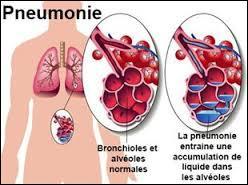 La pneumonie peut-elle concerner un seul lobe pulmonaire ?