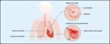 Lequel de ces symptômes peut indiquer une pneumonie ?
