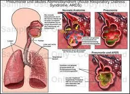 Comment appelle-t-on cette variante de la pneumonie, se limitant aux bronches ?