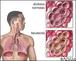 Il est aussi possible de ressentir des douleurs dans la poitrine. Où seraient-elles situées ?