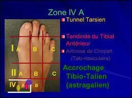 Quelle est la cause du syndrome du tunnel tarsien ant&eacute;rieur ?