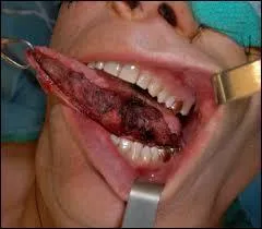 La cigarette ne peut pas être la cause d'un cancer de la langue.