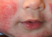 Quiz Partie 1 - Quelques dermatoses et parasitoses du jeune enfant