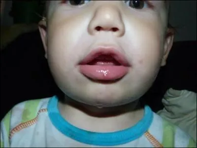 L'aphte et l'herpès sont des lésions ulcéreuses de la muqueuse buccale :