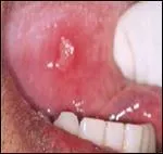 Quels sont les signes cliniques susceptibles de vous faire penser qu'il s'agit d'aphte ou d'herpès ?