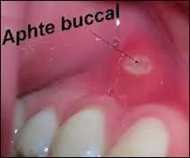 Quels sont les agents responsables de l'aphte et de l'herpès ?