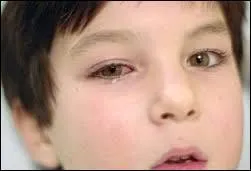 Quels sont les signes cliniques susceptibles de vous faire penser qu'il s'agit de conjonctivite ?