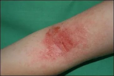 Quelle est l'origine la plus commune de l'eczéma ?