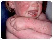 Quels sont les signes cliniques susceptibles de vous faire penser qu'il s'agit d'eczéma ?