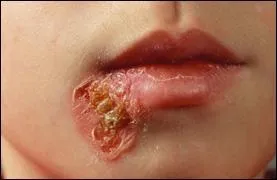 Quelle est l'origine de la dermatose impétigo ?