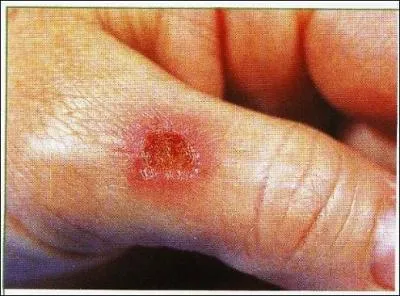 Quel animal ou larve n'est pas utilisé pour des soins médicaux ?