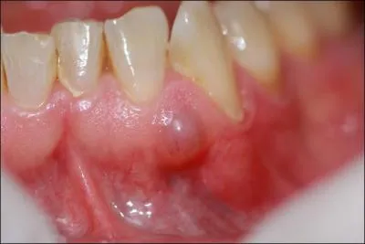 J'espère que vous n'aurez pas une dent contre moi, même si je compte bien vous en mettre plein les gencives : PUE !