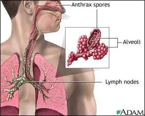 La maladie du charbon a trois formes. Laquelle est la plus mortelle pour l'homme ?