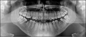 Bien que l'on n'ait que 32 dents, la nomenclature utilisée par les dentistes pour repérer les dents compte une dent 46. 
Quelle est cette dent ?