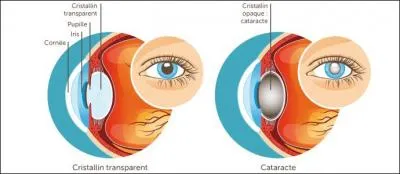Au moyen-âge, que faisait le médecin chrétien, aux personnes qui avaient ce qu'on appelle aujourd'hui la cataracte ?