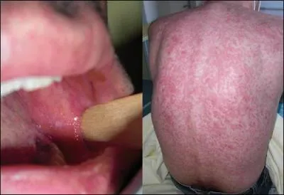 La rougeole se présente comme une grosse rhinite et le corps se couvre peu à peu de maculo-papules.