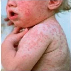 Dans sa phase d'état, la rubéole présente une éruption maculo-papuleuse sur tout le corps et une fièvre modérée.