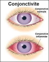 Pour soulager une conjonctivite, je dois :