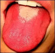 Dans sa phase d'état, la scarlatine présente une langue entièrement blanche.