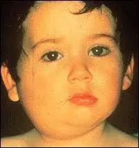 Les oreillons sont dus à :