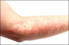 Le psoriasis (cf. photo) n'est pas contagieux.