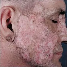 Le lupus est une maladie qui n'existe que chez les vaches.